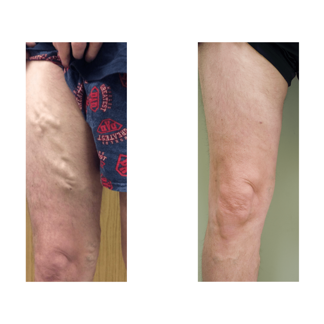 vein before & after -3