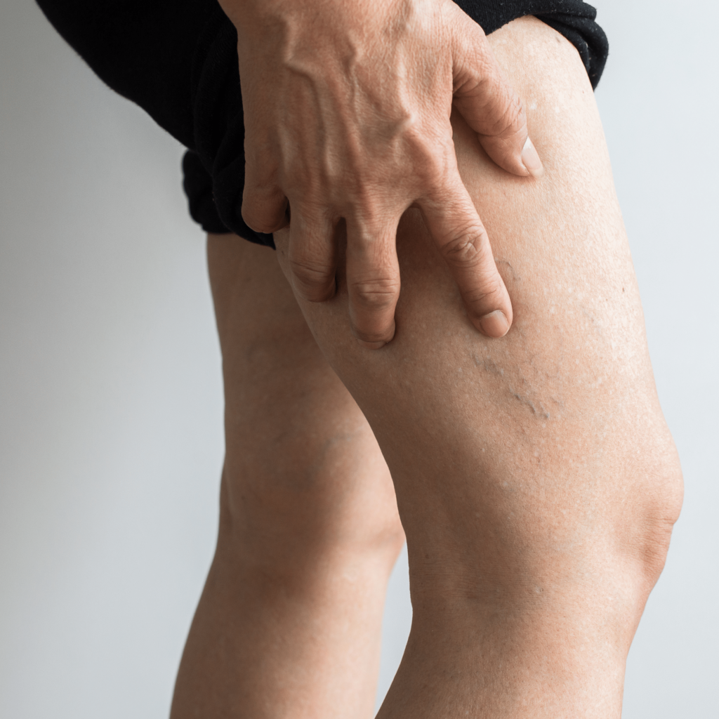 Vein specialists in newington ct