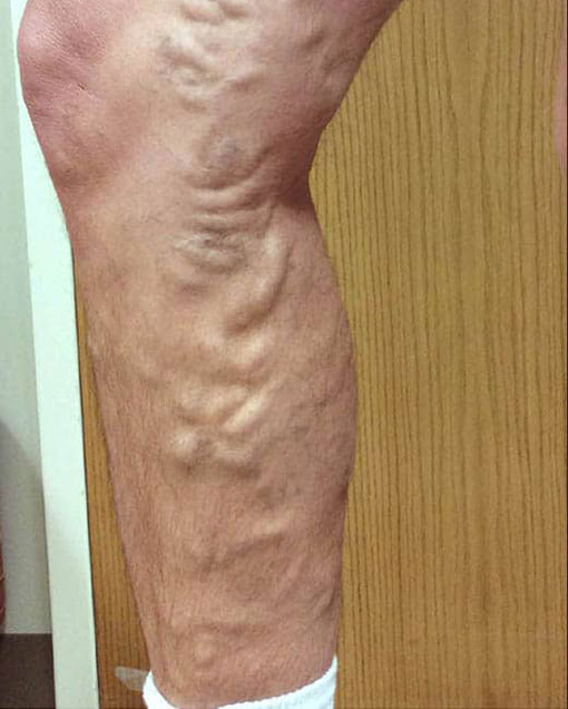 varicose veins treatment newington ct