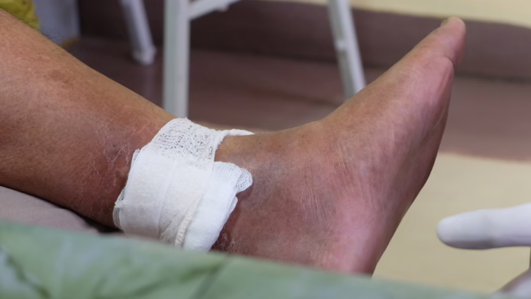 The Wound That Won't Heal: Understanding Venous Leg Ulcers