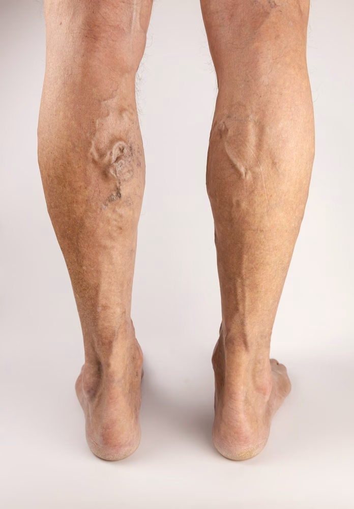 Vein specialists in springfield ma