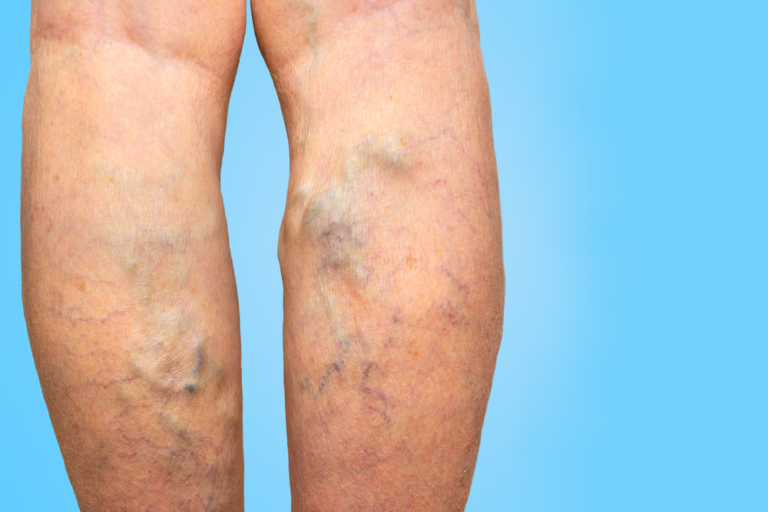 What Happens if Varicose Veins are Left Untreated
