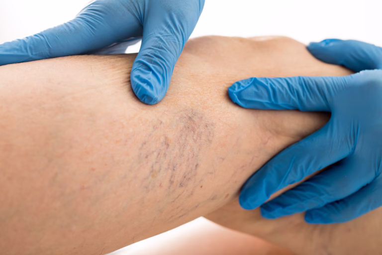 Understanding Spider Veins: A Guide to Clinical Solutions