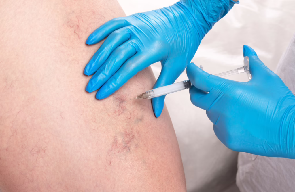 varicose veins in farmington
