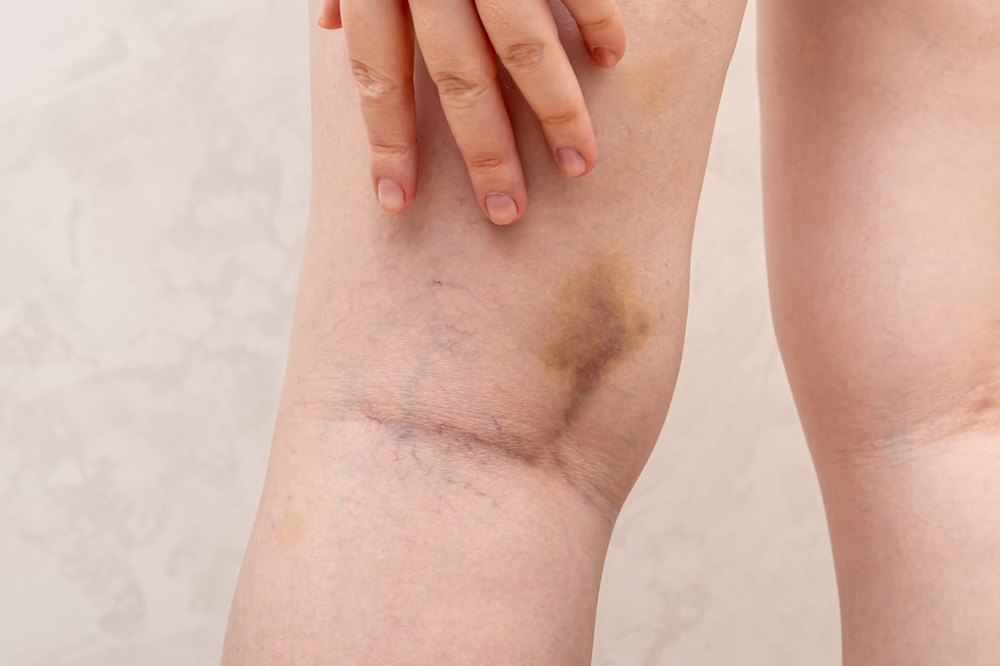 The Connection Between Varicose Veins and Easy Bruising